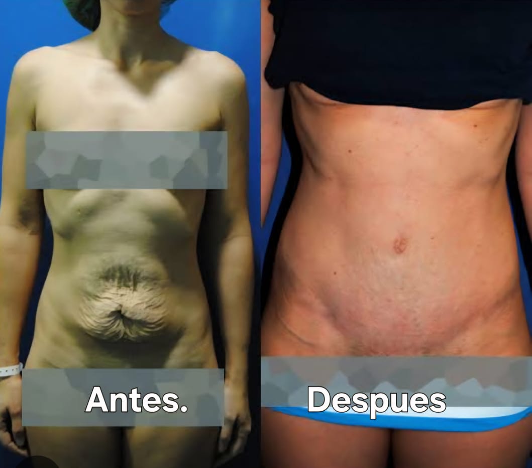 Resultado Miniabdominoplastia 5